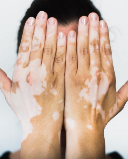 Vitiligo,On,The,Hands,With,White,Background
