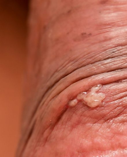 Herpes,On,The,Penis,sexually,Transmitted,Deseases,,Bumps,On,The,Skin,
