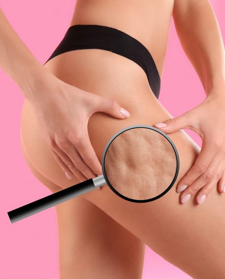 Cellulite problem. Slim woman in underwear on pink background, closeup. Zoomed skin with orange peel syndrome, view through magnifying glass